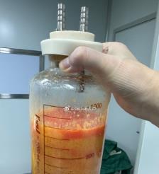 海西水动力吸脂手术要做多久？